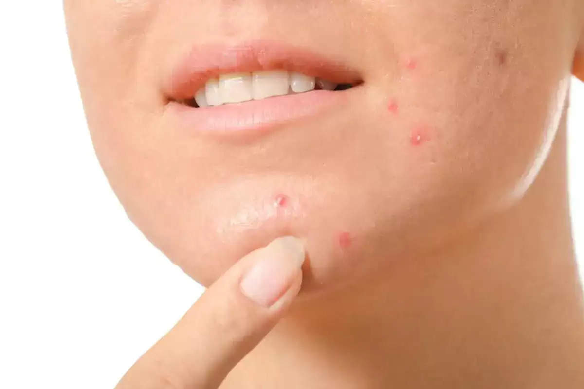 Pimples RemoveTips