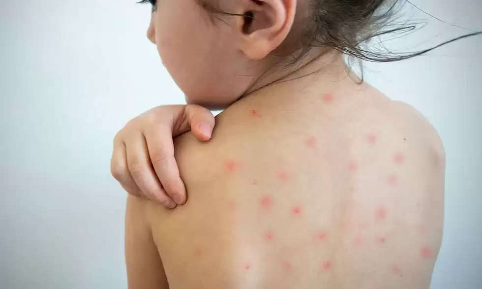 Measles Outbreak